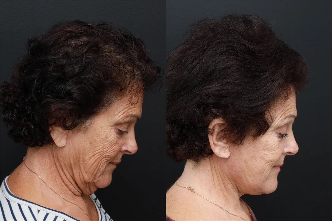 86595-Right Lateral Neck Flexed combined