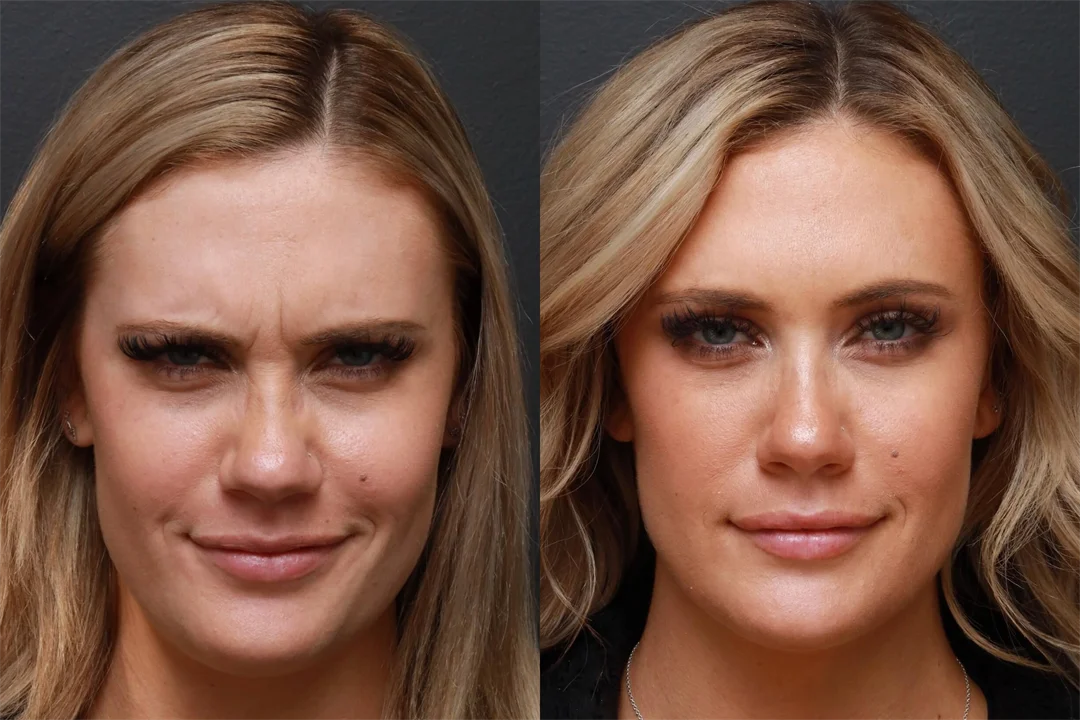 86836-AP Frown combined