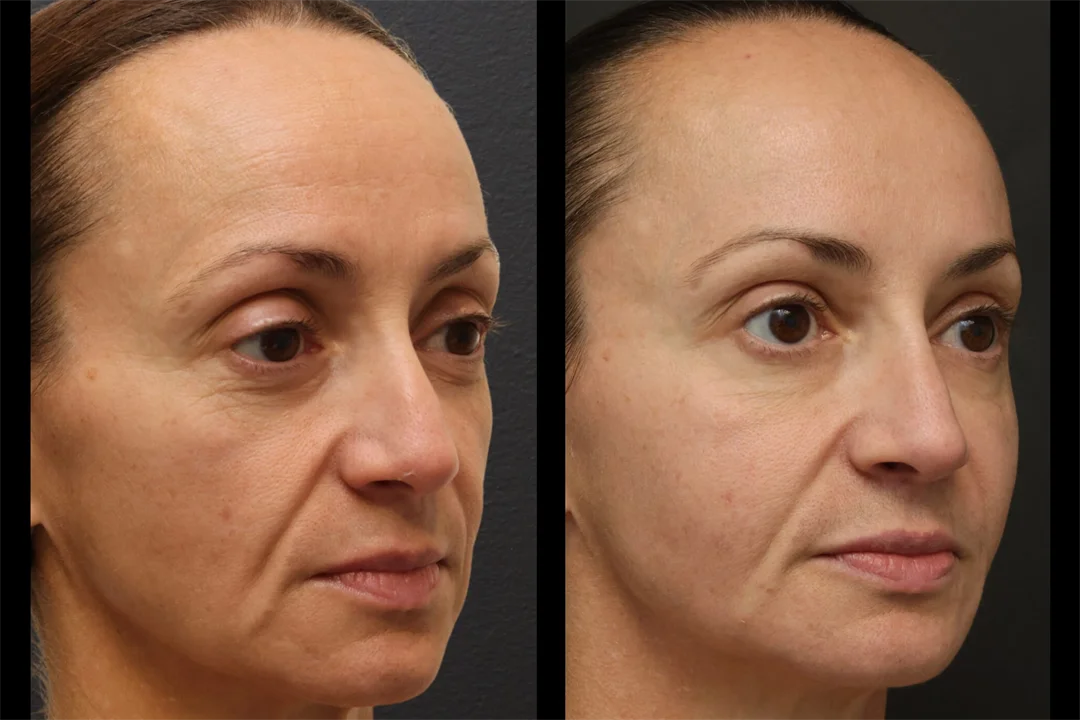 87463-Right Oblique combined