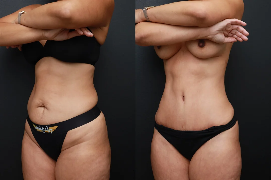 87617-Left Oblique combined