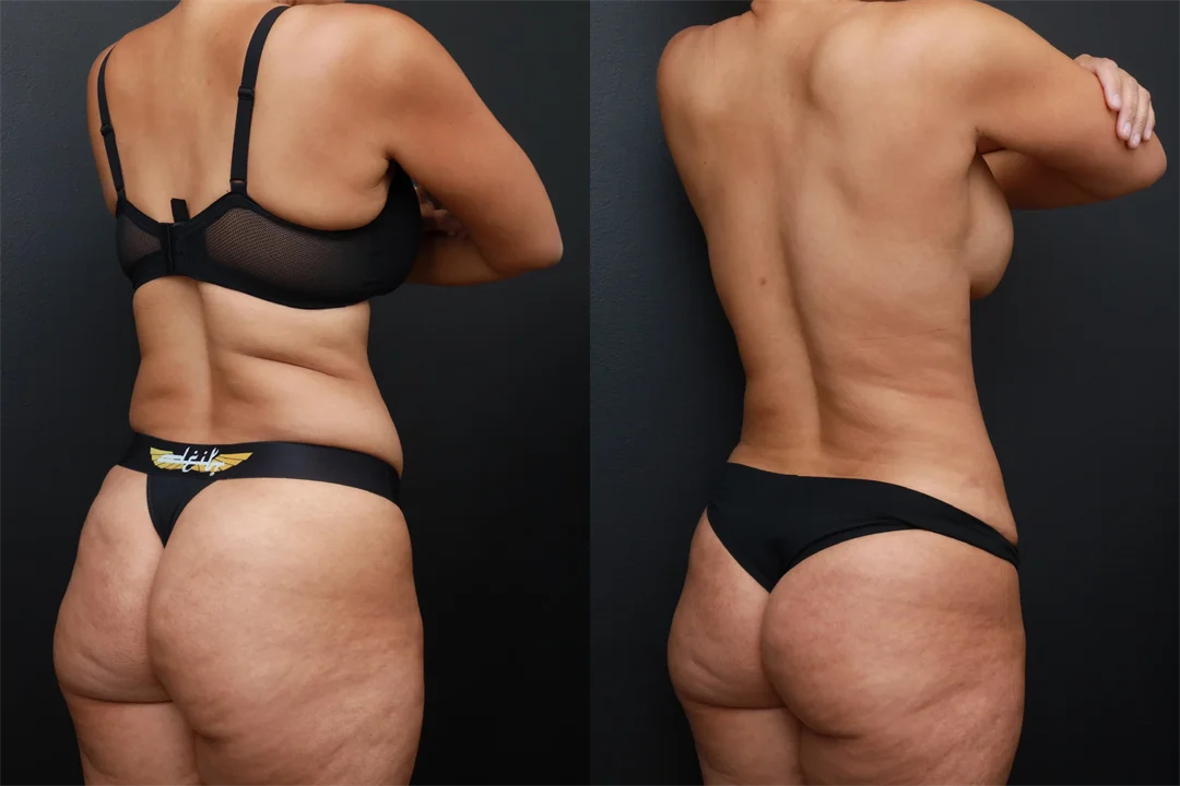 87617-Right Back Oblique combined