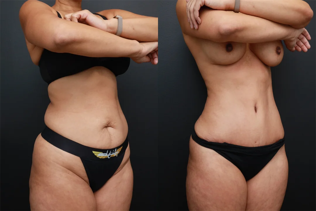 87617-Right Oblique combined