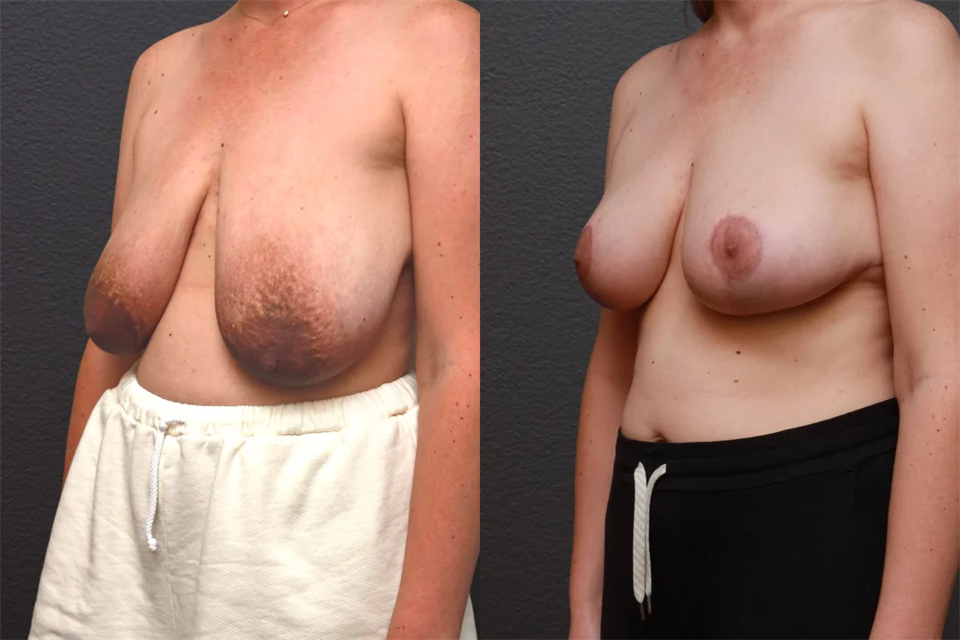 87717-Left Oblique combined