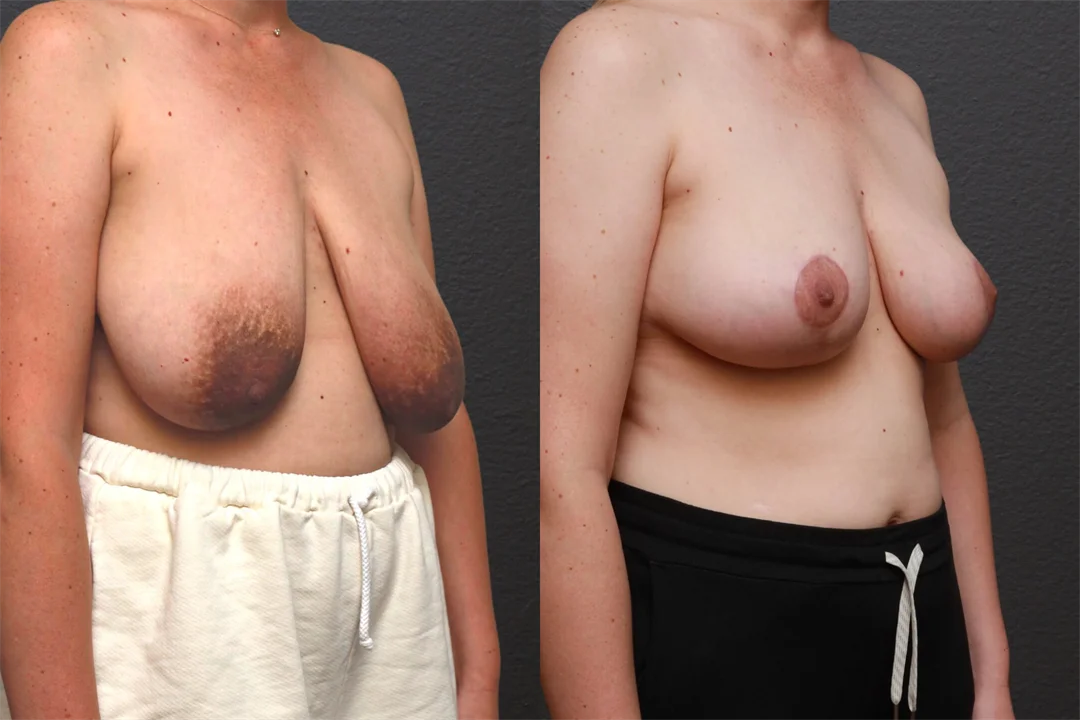 87717-Right Oblique combined