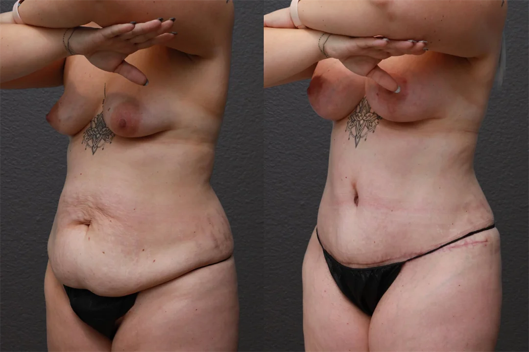 87982-Left Oblique Before