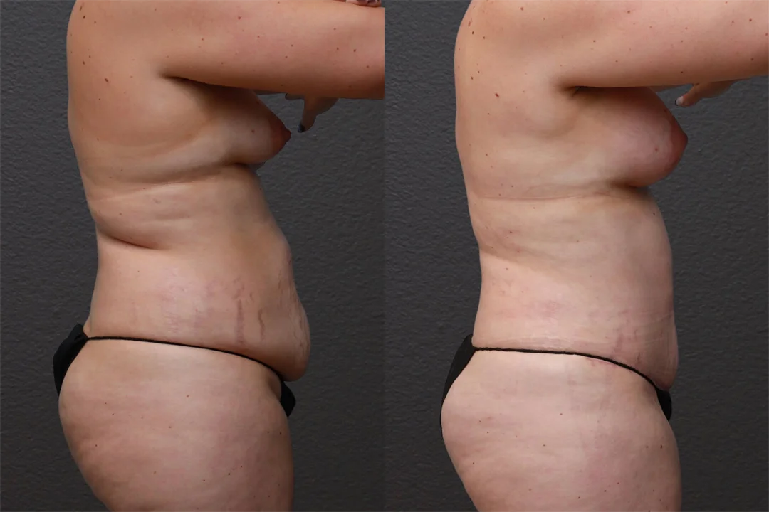 87982-Right Lateral Before