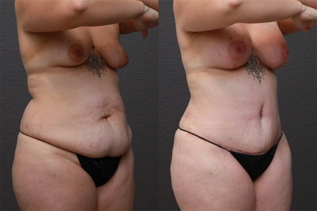 87982-Right Oblique Before