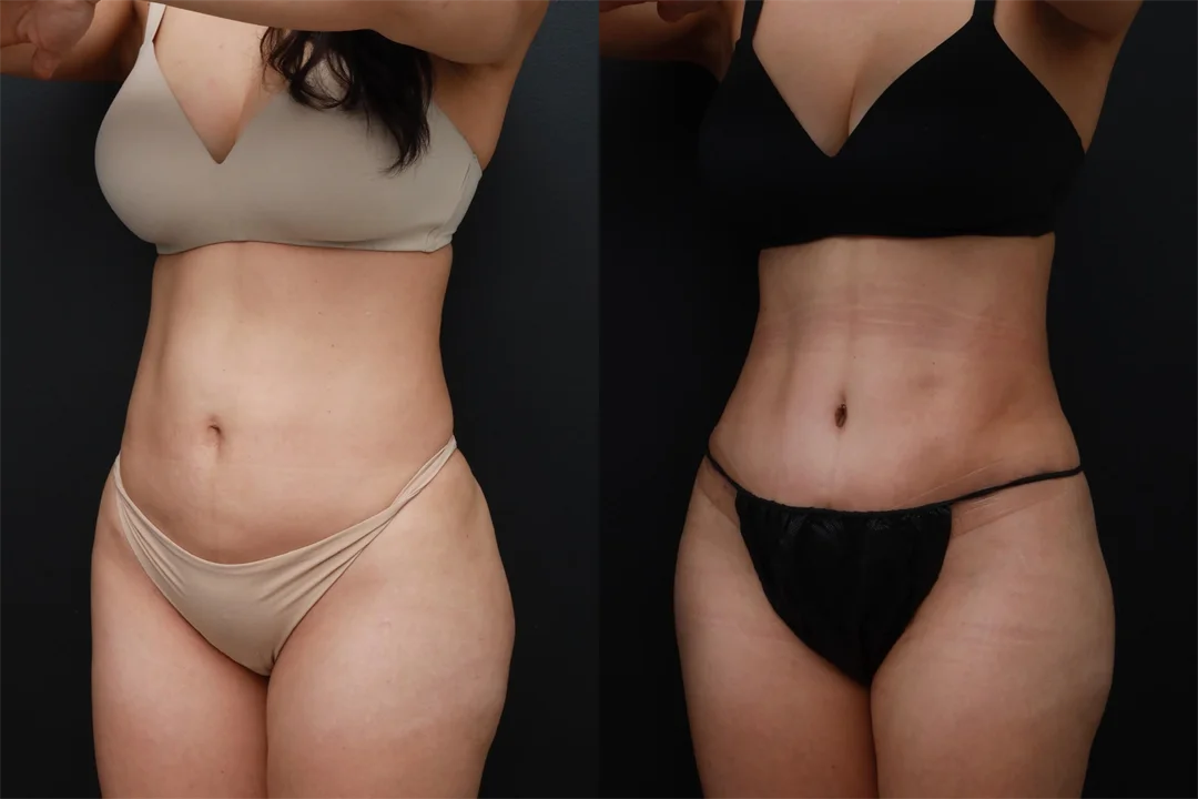 89803-Left Oblique combined