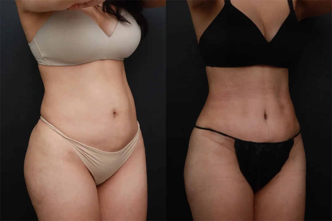 89803-Right Oblique combined