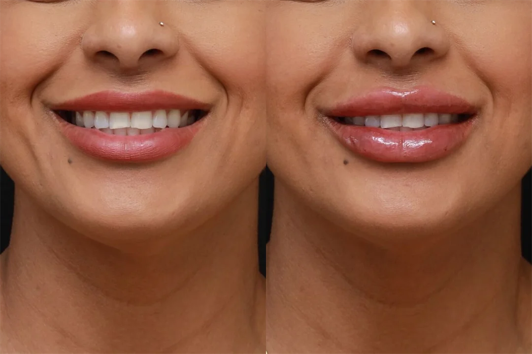 90111-AP Smiling combined