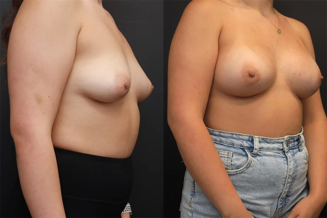 92103-Right Oblique combined