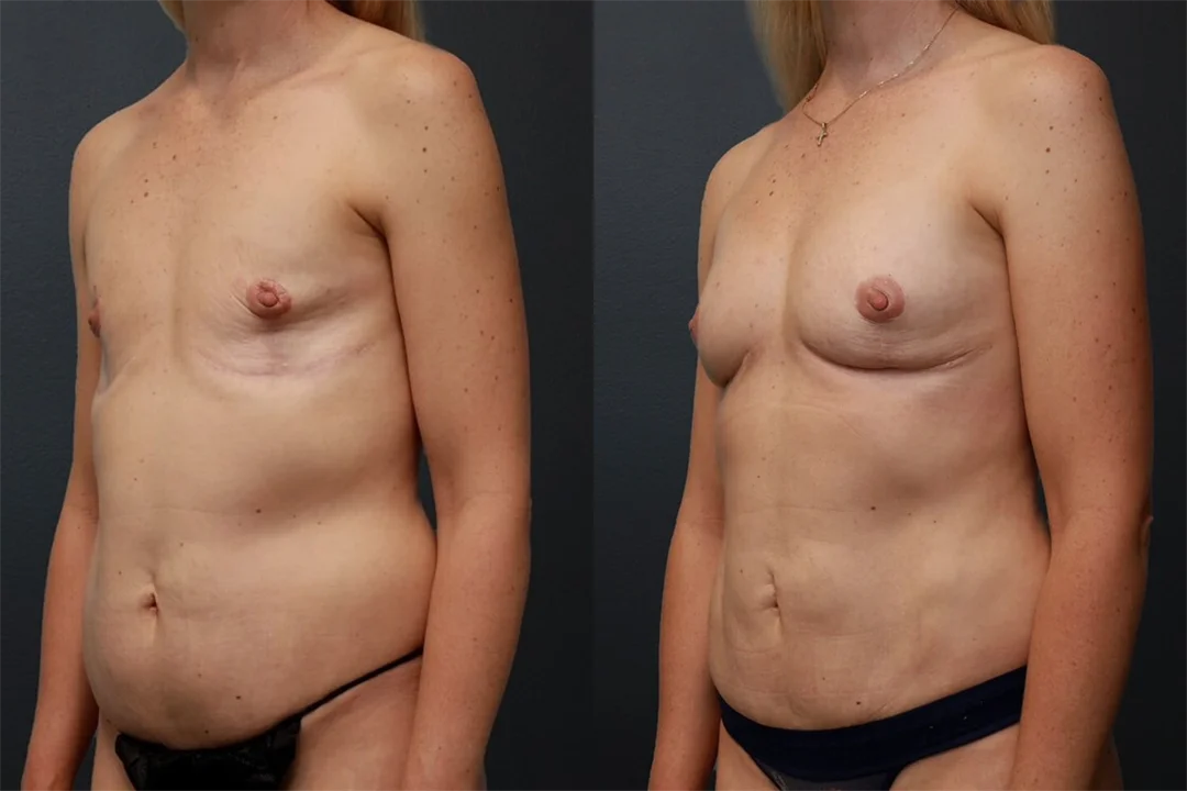 92187-Left Oblique combined