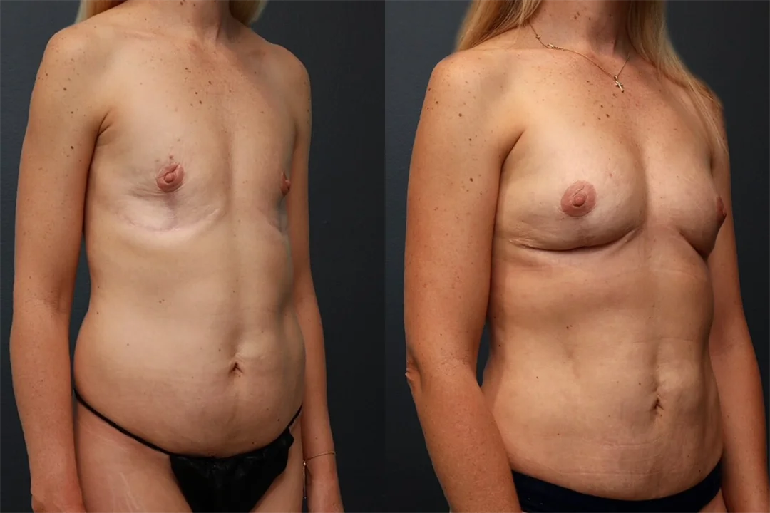 92187-Right Oblique combined