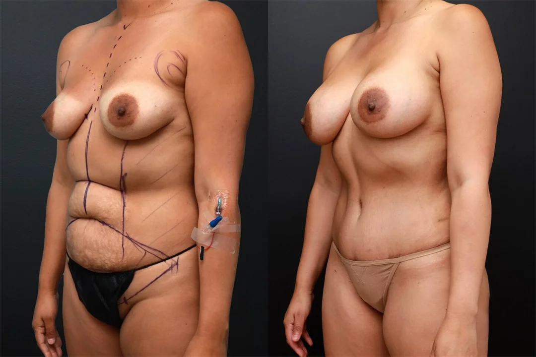 92516-Left Oblique combined