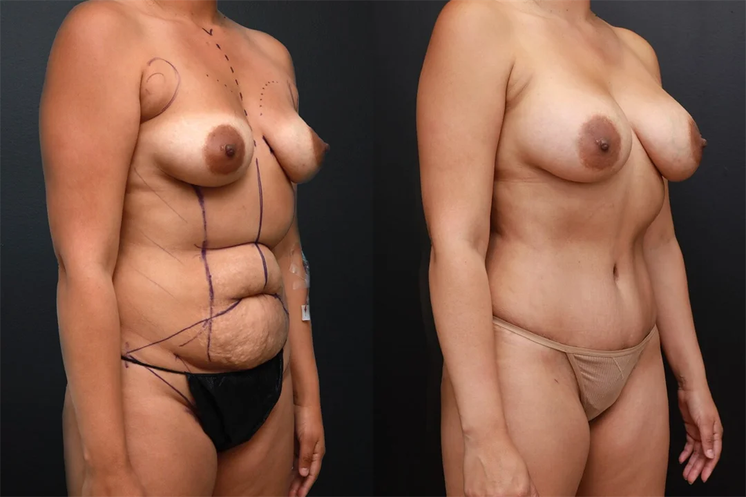 92516-Right Oblique combined