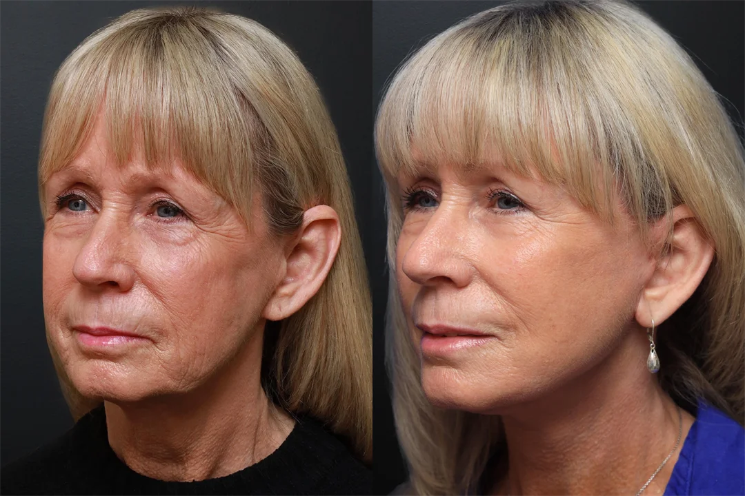 92970-Left Oblique combined