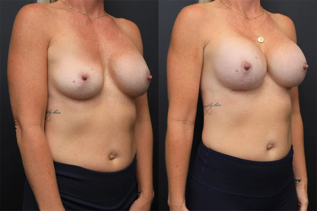 93836-Right Oblique combined