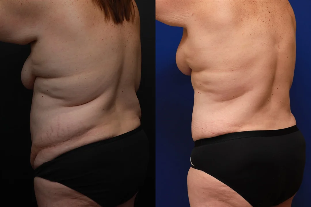 94146-Left Anterior Oblique combined