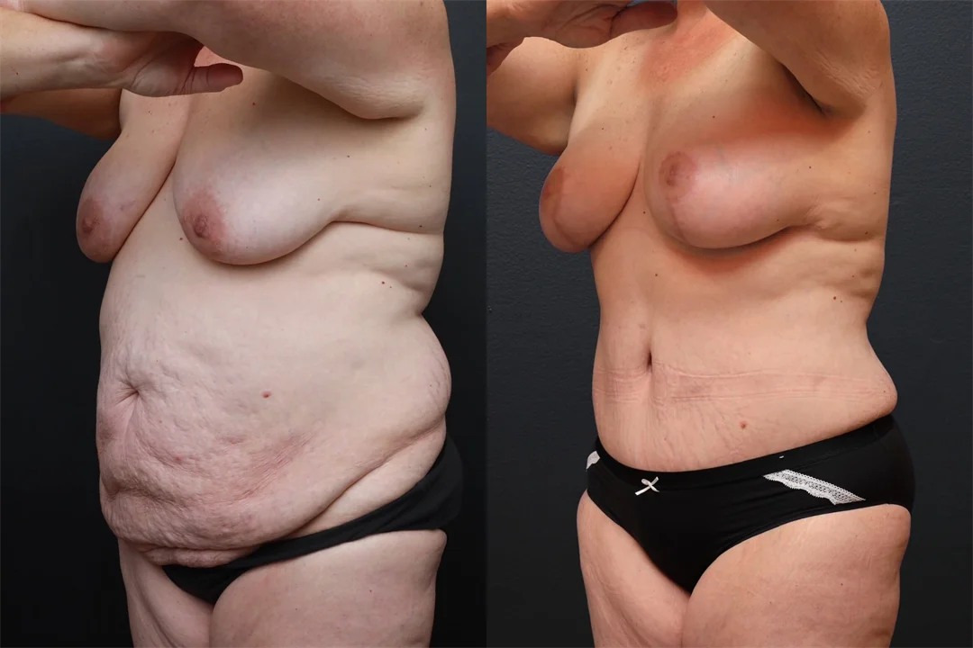 94146-Left Oblique combined