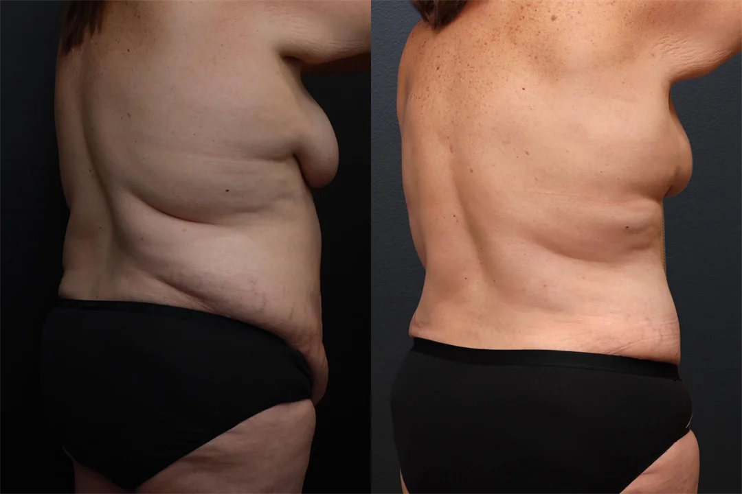 94146-Right Anterior Oblique combined