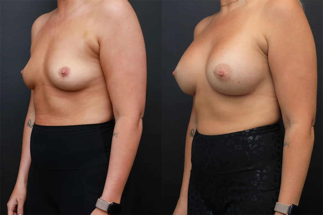 94266-Left Oblique combined