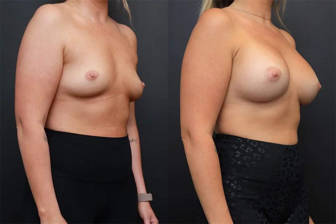 94266-Right Oblique combined