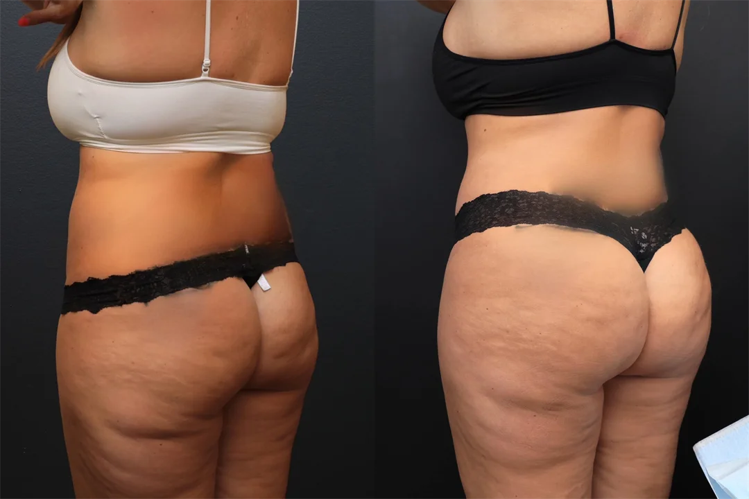 94403-Left Posterior Oblique combined