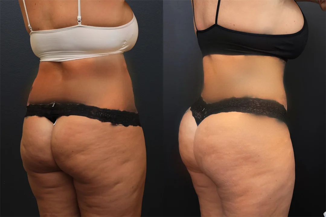 94403-Right Posterior Oblique combined