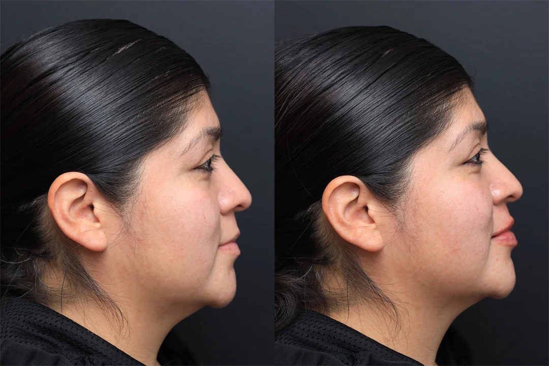94495-Right Lateral Lips combined