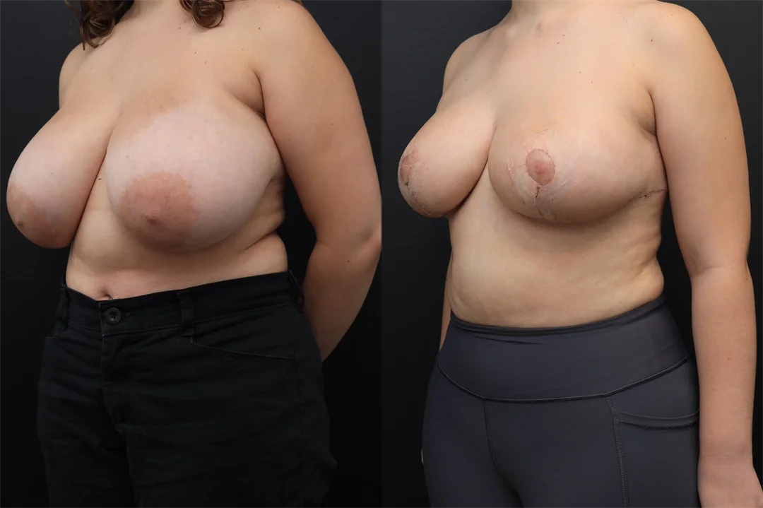 94593-Left Oblique combined