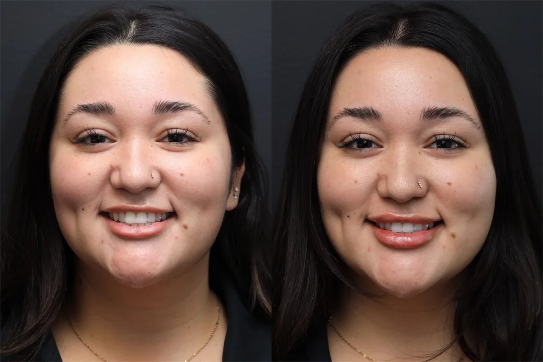 95517-Frontal Smiling combined