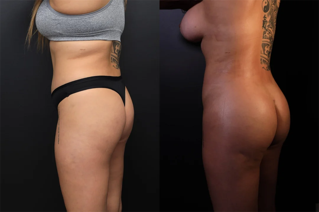 95518-Left Oblique- Posterior combined