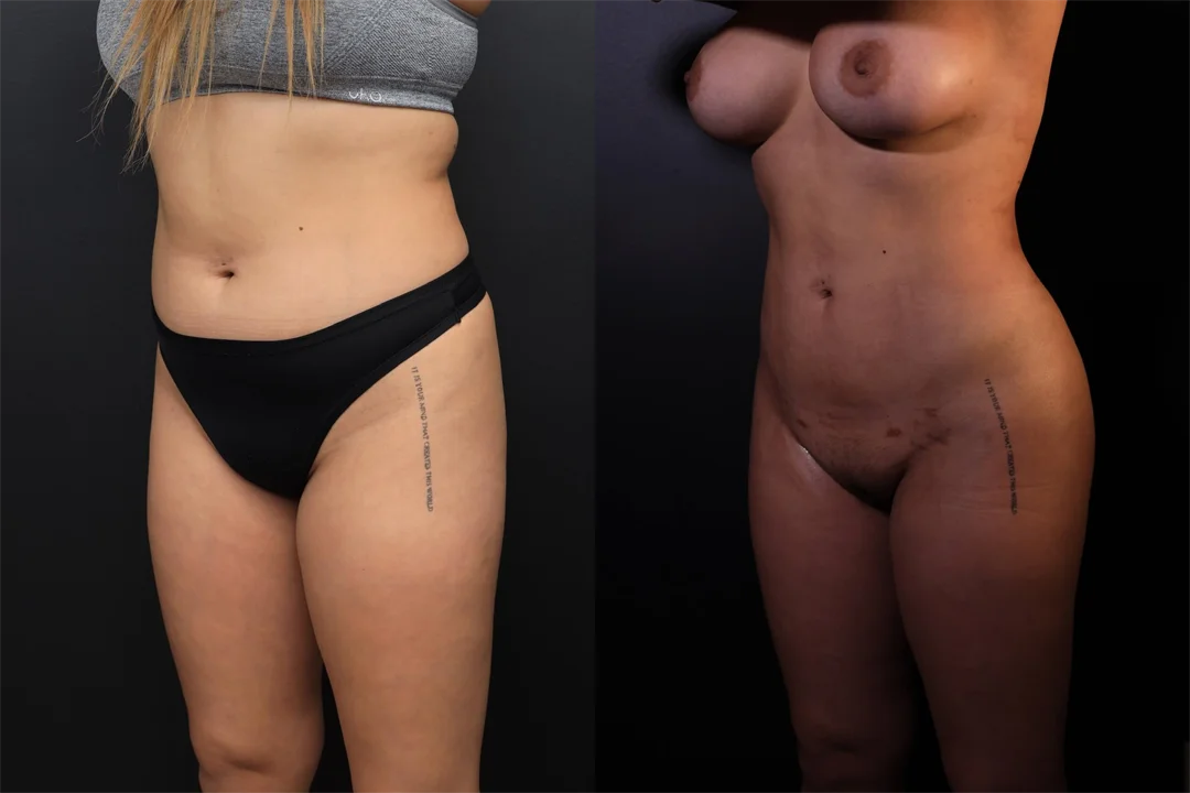 95518-Left Oblique combined