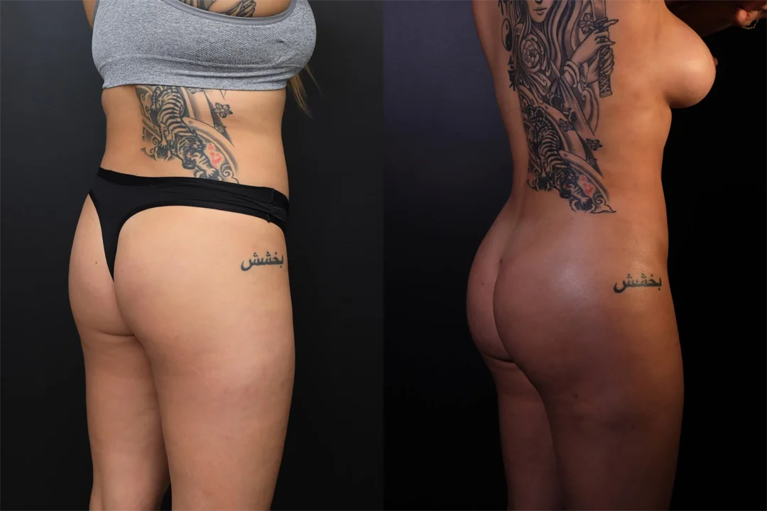 95518-Right Oblique Posterior combined