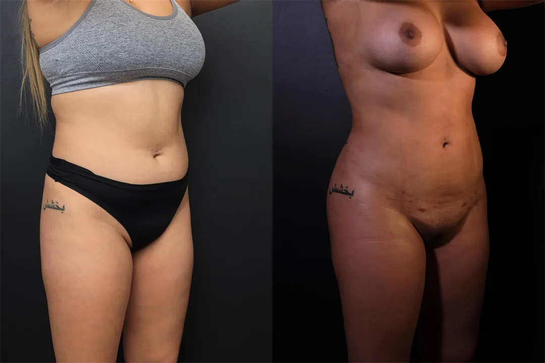 95518-Right Oblique combined