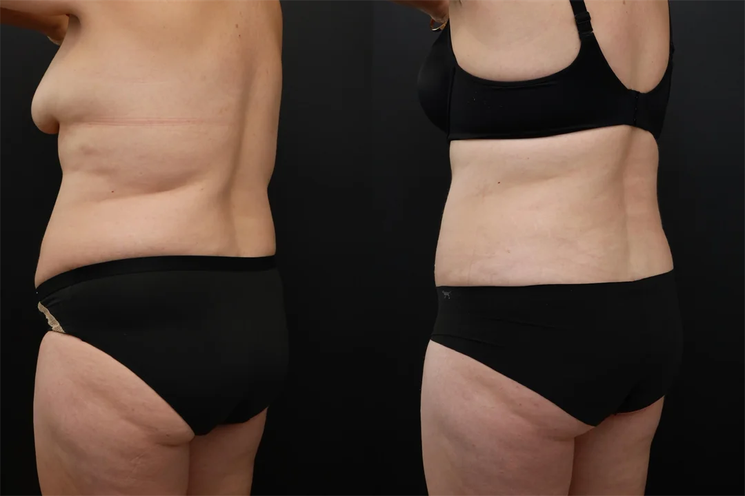 95519-Left Oblique Posterior combined