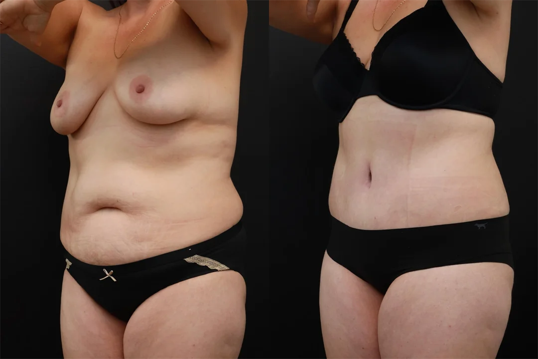 95519-Left Oblique combined