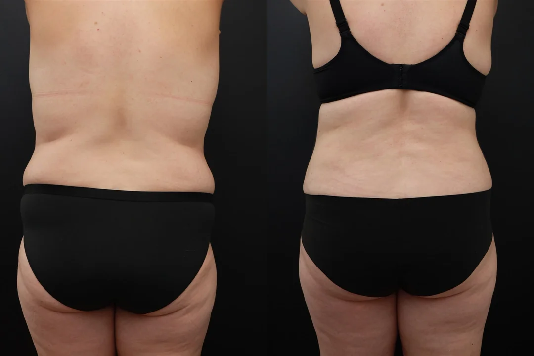 95519-Posterior combined