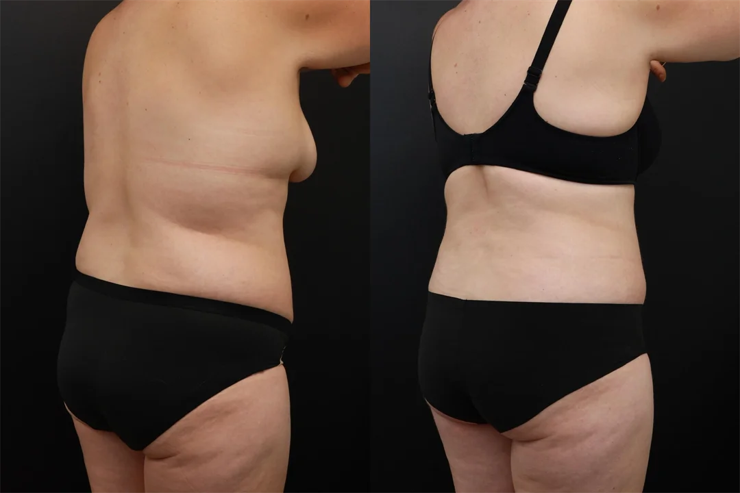 95519-Right Oblique Posterior combined