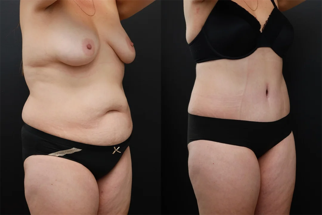 95519-Right Oblique combined