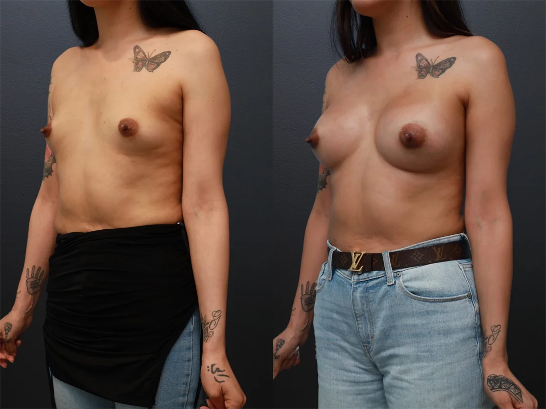97222-Left Oblique combined