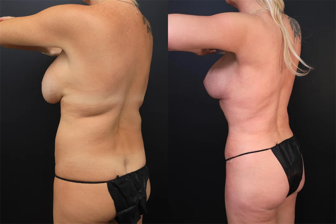 97384-Left Posterior Oblique combined