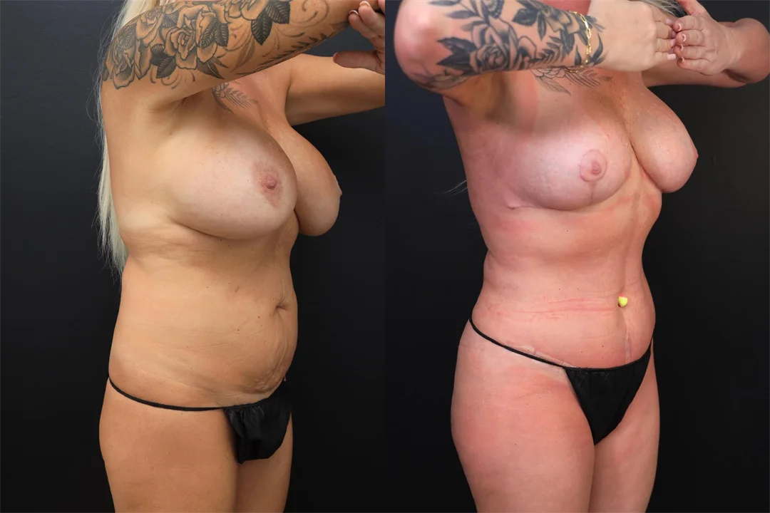 97384-Right Oblique combined