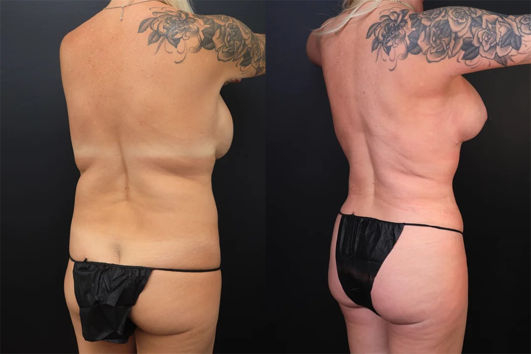 97384-Right Posterior Oblique combined