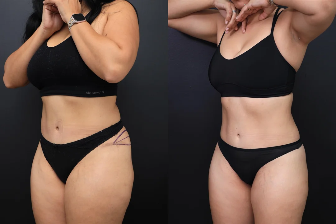 97657-Left Oblique combined