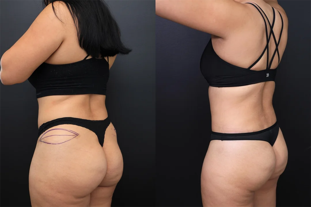 97657-Left Posterior Oblique combined