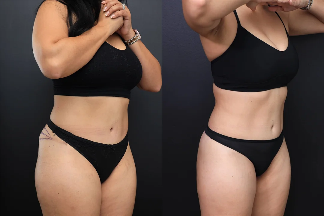 97657-Right Oblique combined