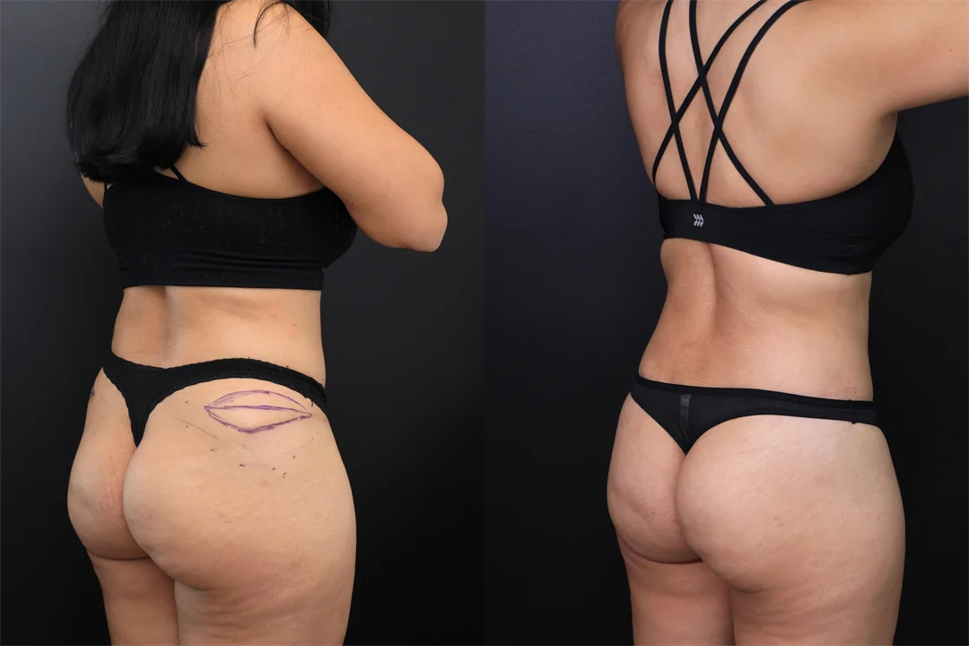 97657-Right Posterior Oblique combined