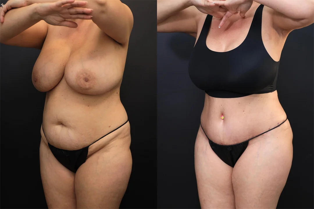98054-Left Oblique combined