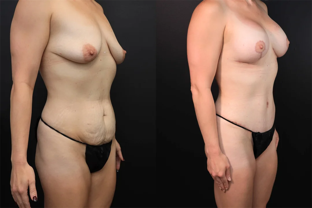 98449-Right Oblique combined